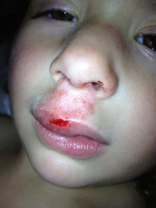 Day of injury. Swollen nose, upper lip abrasion, and a short but deep laceration to the upper lip.