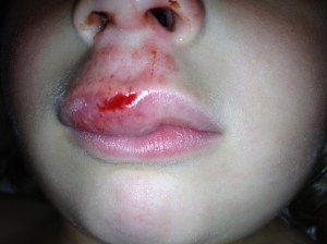 On closer inspection, the laceration does not cross the vermillion border, but does abut it. It is short but deep and bleeding a fair amount.