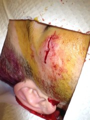 First, several 5-0 vicryl deep dermal sutures were placed to remove some of the tension on the wound.