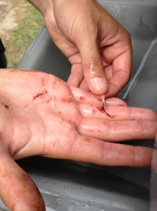 Hand laceration seen at the RockMed Tent at Outside Lands. 