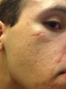 The appearance of the laceration at 3 months post injury.