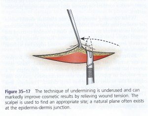 Cartoon diagram of undermining, from Roberts & Hedges text Clinical Procedures in Emergency Medicine, 5th edition.
