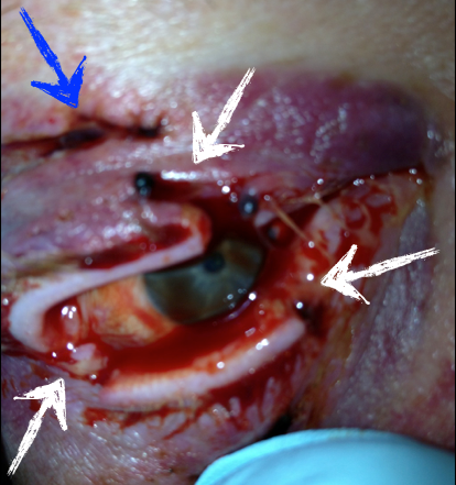 The blue arrow indicates a laceration through the upper eyelid. The white arrows indicate lacerations involving the eyelid margins.