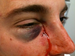 A young man who fell, and his glasses shattered cutting through his face medial to the eye.