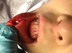 The laceration didn't look like much at first glance, but on closer inspection, it's actually through-and-through the intra-oral mucosa to the epidermis!