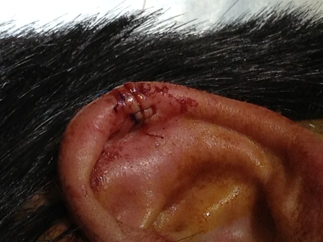 Small auricular hematoma formation after repair of an ear laceration.