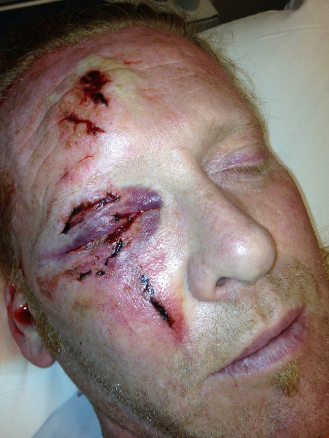 A patient with multiple lacerations to the eyelid after a fall.