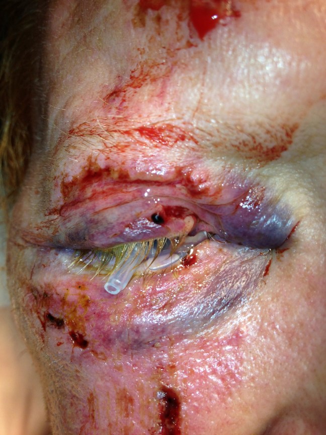 A Morgan Lens placed in the eye acts as a great barrier under the lid to prevent iatrogenic globe puncture while suturing.