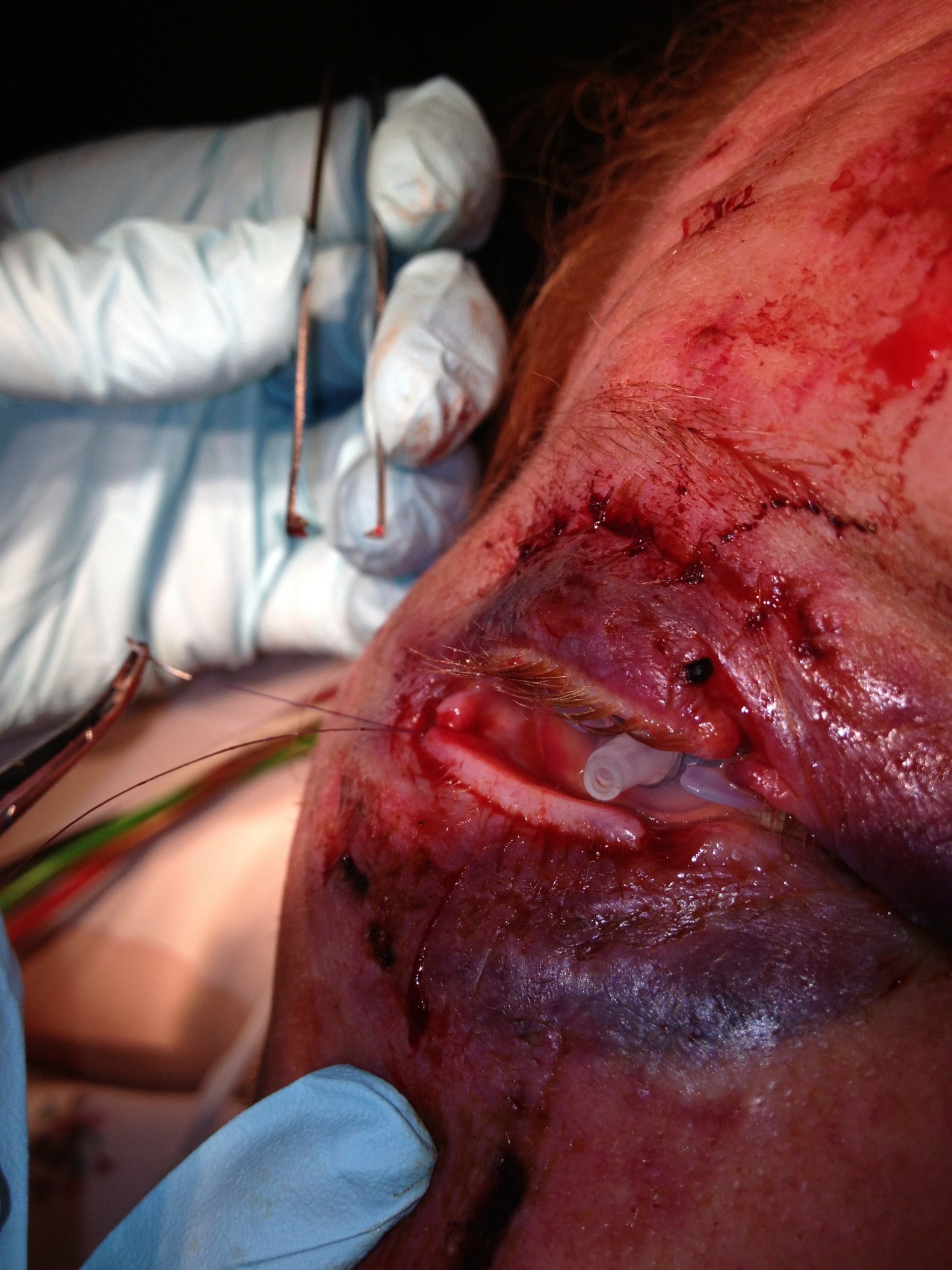Lacerations Around The Eye Closing The Gap Lacerations Around The Eye Closing The Gap