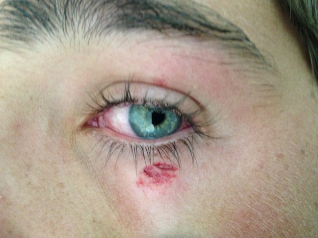 Can this minor laceration under the eye be safely closed with tissue adhesive, without glueing the eye shut?