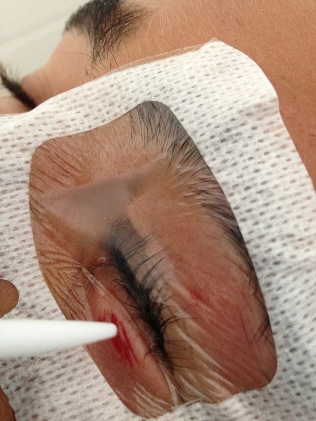 The wound can now be safely accessed for glue application. Any glue 