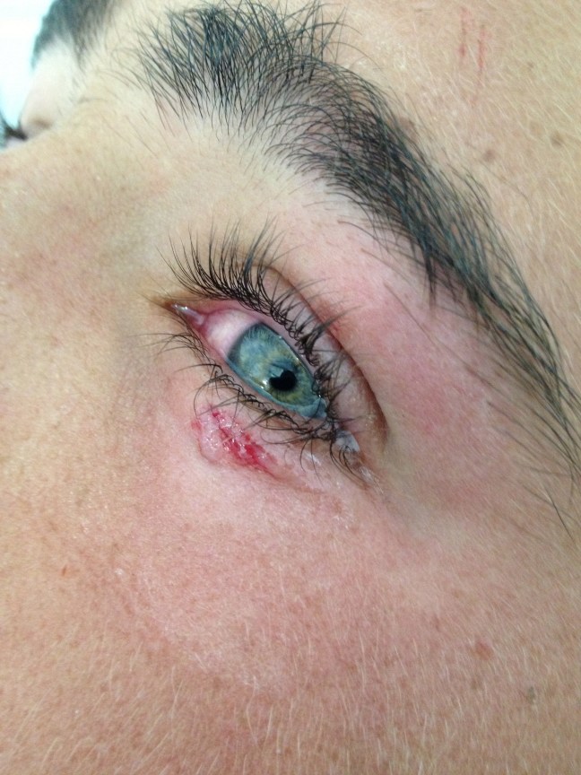 The laceration has been repaired with glue, sans mess or temporary glued-shut-eye-blindness.