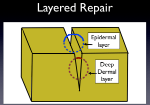 Cartoon depiction of layered closure. The red suture is a simple interrupted deep dermal suture, placed underneath the skin surface to relieve tension and close dead space. The blue suture is a simple interrupted epidermal suture, which approximates the skin surface and will require later removal.