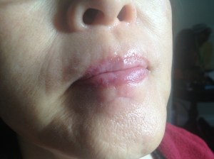 A photograph of the laceration's appearance at 6 months.