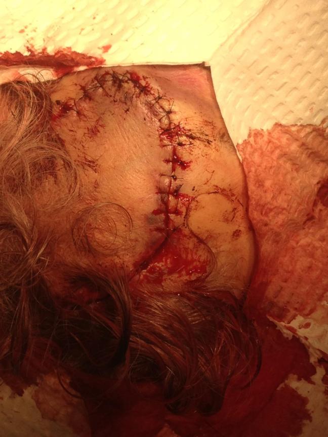 Forehead laceration, after meticulous repair with simple interrupted 6-0 nylon sutures.