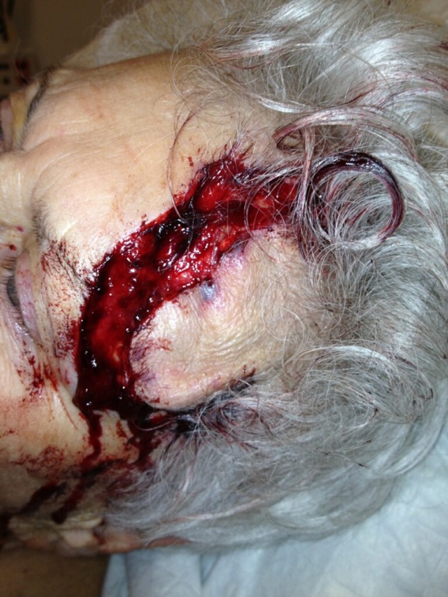 Extensive forehead laceration, with large delay in presentation due to poor mobility.