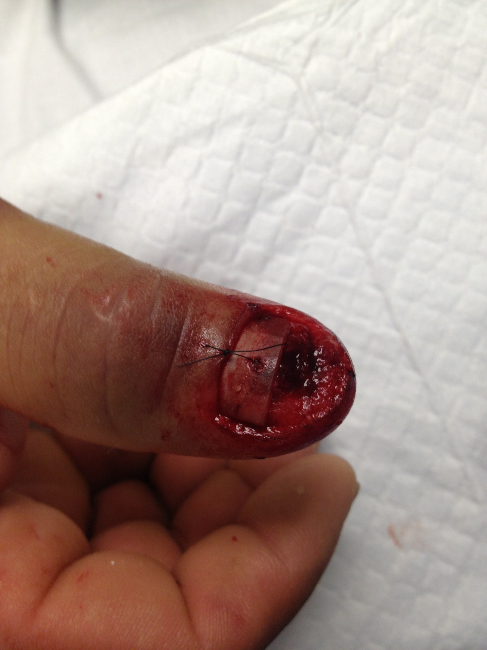 Nail Inposed NailBed Injuries, Part II β Closing the Gap