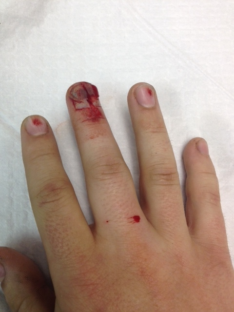 A nailbed laceration caused by a skill saw. The proximal nail fold is avulsed, and the nail is lacerated in several places.