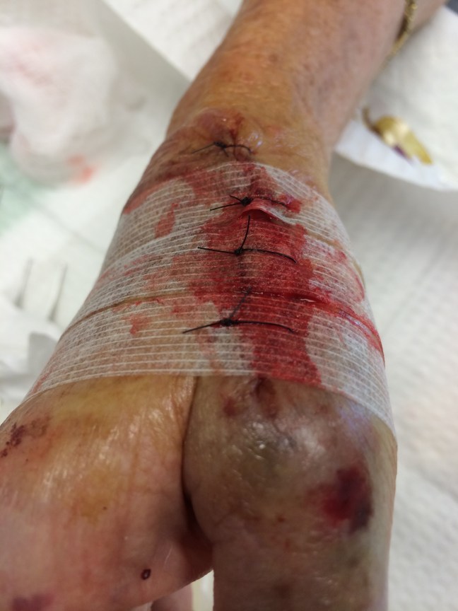 Tissue adhesive tape is placed in the usual fashion across the wound, then sutures are placed through and through the strips to relieve tension on the skin surface.