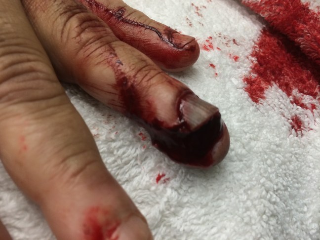An extensive fingertip injury caused by a power tool. The nail, skin, and subcutaneous tissue are involved. Underlying distal phalanx tuft fracture is also present.