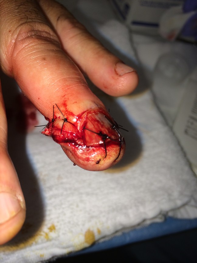 Repair of the skill saw injury previously pictured. Simple interrupted sutures allowed excellent approximation of the wound margins without nail removal.