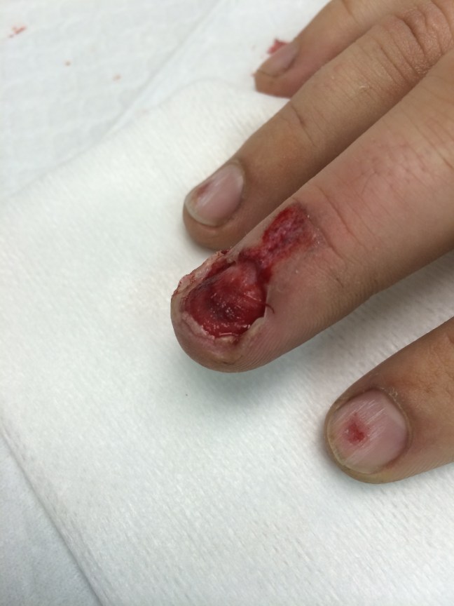 The nail was removed, revealing this underlying nail bed laceration.
