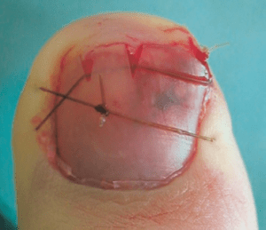 Actual photograph of a nail bed figure-of-8 repair, from the article by Bristol and Verchere.