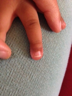 Incredible healing of the 3 year old from the first case seen at months. The nail was secured in place but not removed. a testament to the healing power of children!
