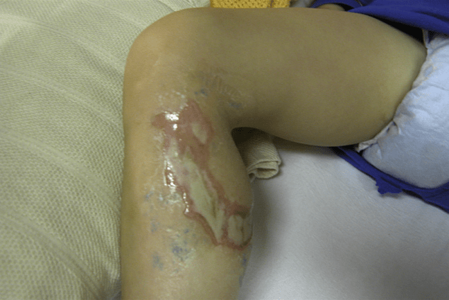 A full thickness burn from cyanoacrylate glue, image as published in the case report by Clarke, TFE in the Journal of Plastic, Reconstructive, and Aesthetic Surgery.