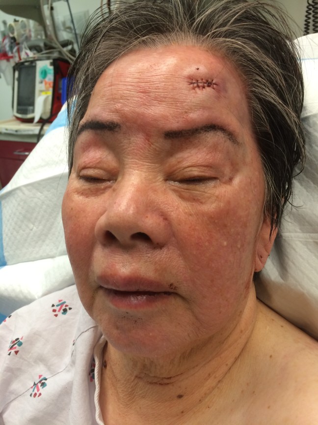 After ligation of a small arterial pumper, the wound was closed with fast absorbing plain gut absorbable sutures.