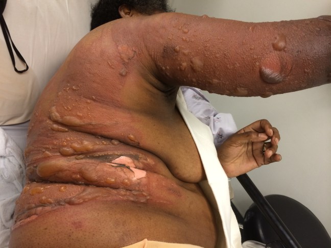 A 44 year old female with a scald burn injury to her trunk and arm.