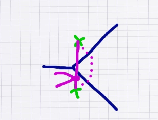 Tying the suture transforms the wound shape from a 