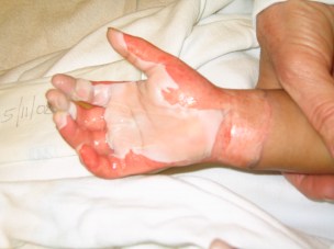 A full thickness burn wound to the hand of a child. Note the white, waxy areas surrounding erythematous areas of partial thickness burn.