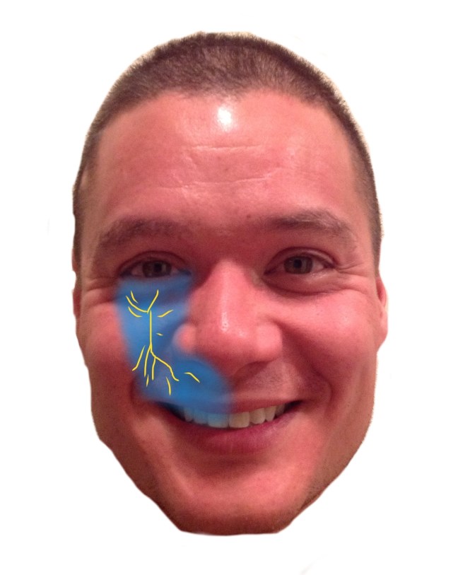 face infraorbital block w nerve