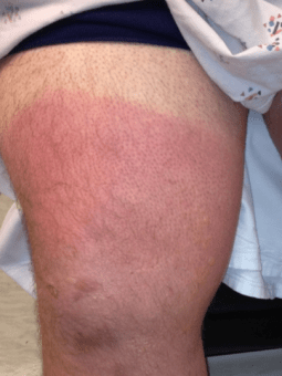 A superficial (aka first degree) burn wound injury, sustained on the leg of a patient on an all day river rafting trip without sun protection.