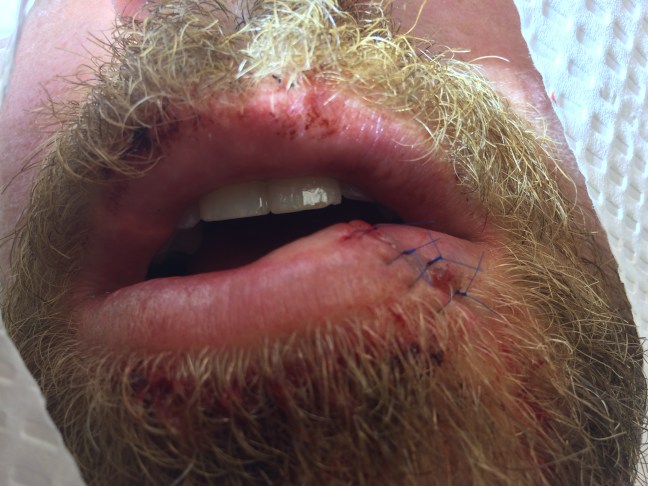 Sutures of a different color than the patient's facial hair are important to ensure each suture loop is readily identifiable for removal.