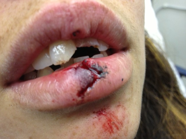 When teeth are chipped (often the case with lip lacerations), ensure no fragments remain embedded in the wound. 