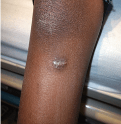 A range of outcomes were noted with vicryl rapide repair. Generally, a less well-perfused and higher tension area led to more noticeable scarring, which is also true of the non-absorbable counterparts. Photo courtesy Dr. Cena Tejani.