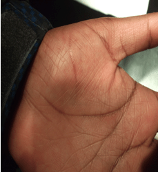 Look ma, no scar! Three month outcome in a hand laceration repaired with vicryl rapide. Courtesy Dr. Cena Tejani.