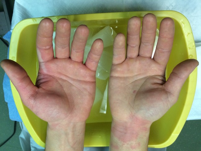 Superficial partial thickness burns of the hands, sustained with hot oil while cooking.