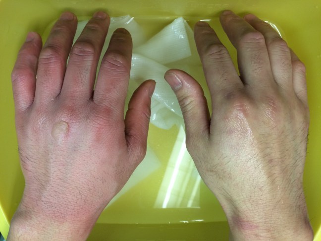 Superficial partial thickness burns of the hands, caused by hot oil while cooking.