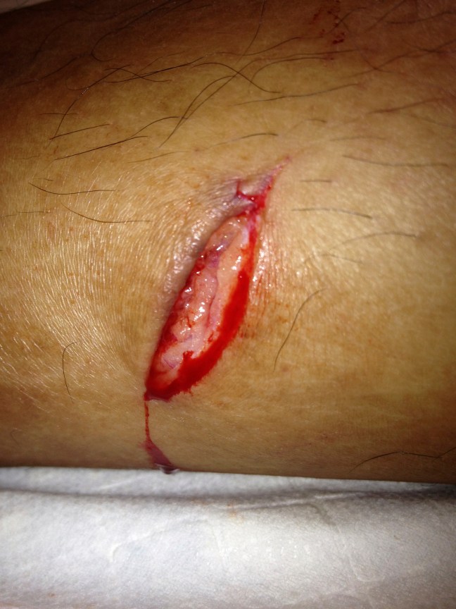 A traumatic, straight laceration of the leg. The linear, clean wound edges made it a reasonable candidate for running subcuticular closure. However, given its riskier location with regards to infection, I didn't want to leave embedded suture material.