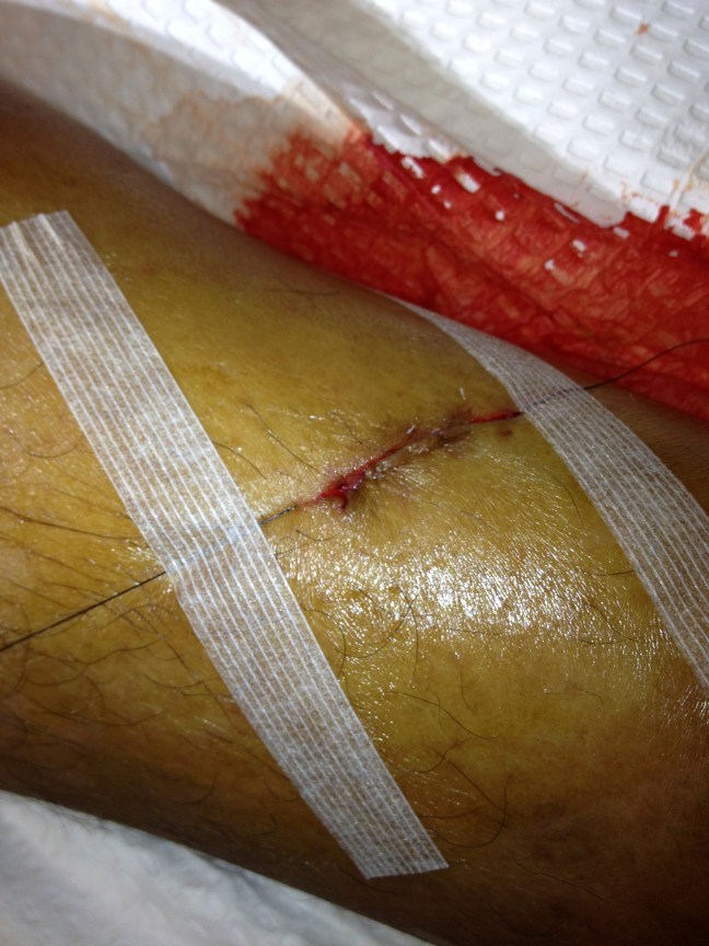 After running the suture and opposing the edges with nylon, the edges were taped down with tissue adhesive tape.