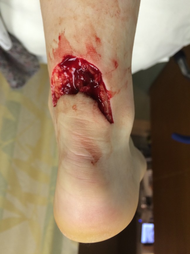 Posterior leg laceration caused by a broken mirror. What underlying structure is at risk?