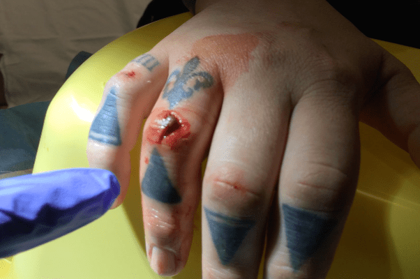 A small laceration over the extensor surface of the proximal interphalangeal joint. What is the concern with an injury like this?