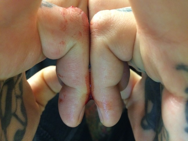 By way of comparison: a normal modified Elson's test, where the distal phalanges are limited in extension. Again, the key is assessment of the symmetry. 