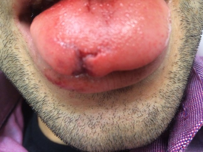 A tongue laceration greater than 1 cm which splays the margins of the tongue would likely benefit from primary repair.
