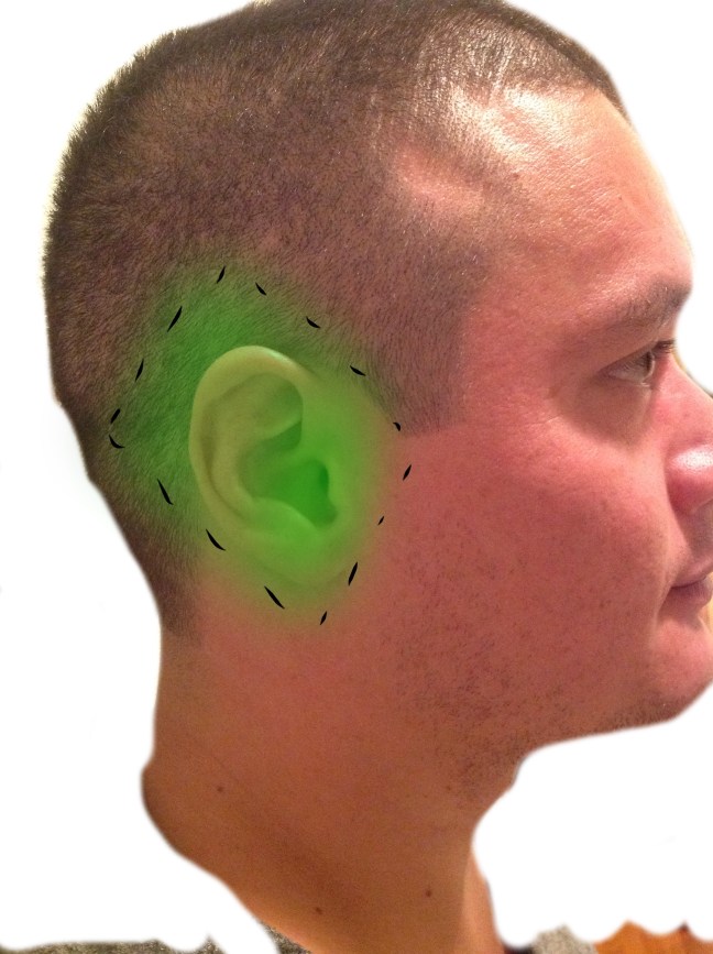 Achieving anesthesia of the sensitive ear is important prior prior to any painful procedure.