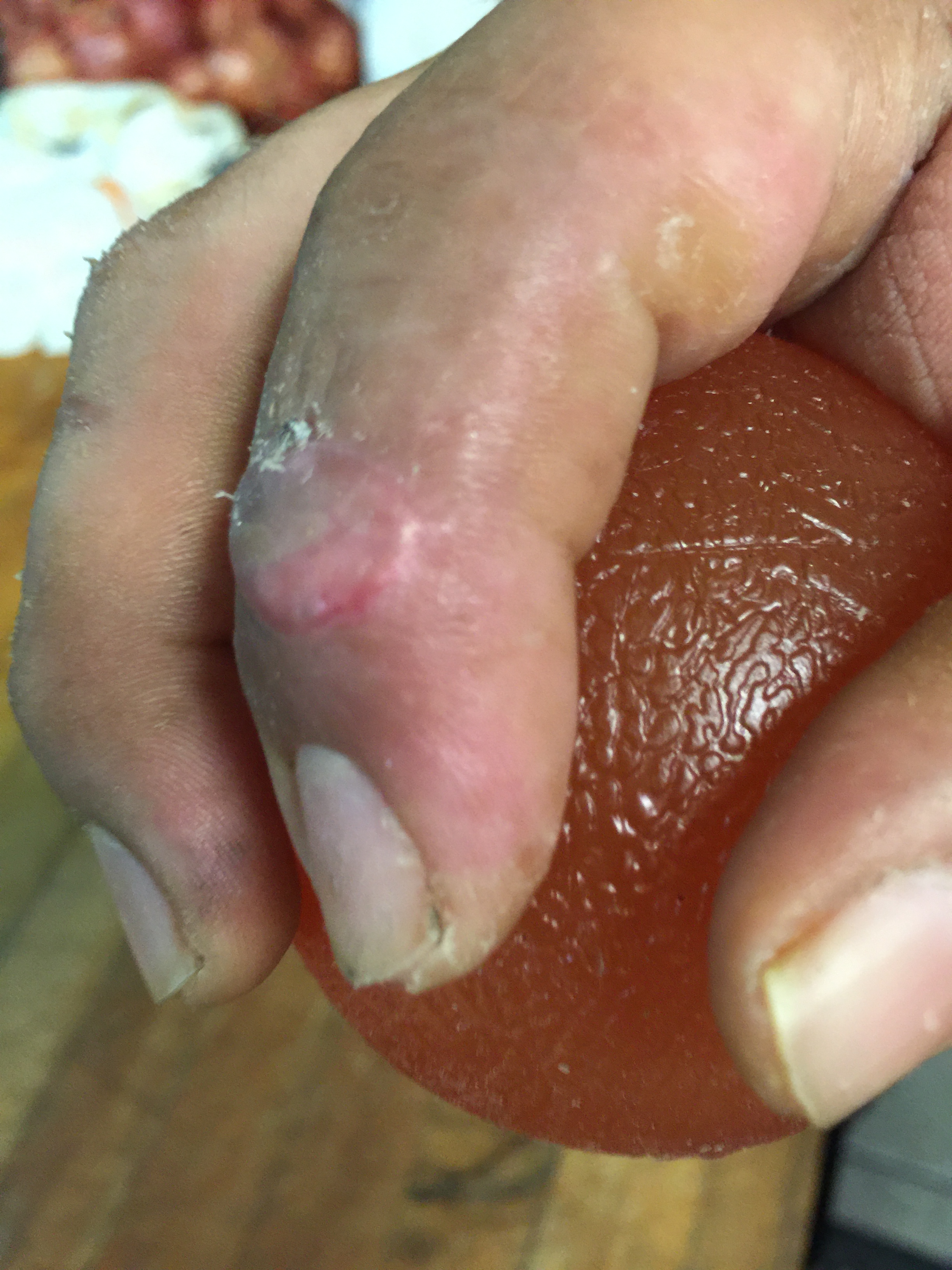 hypothenar graft 6 weeks1.JPG