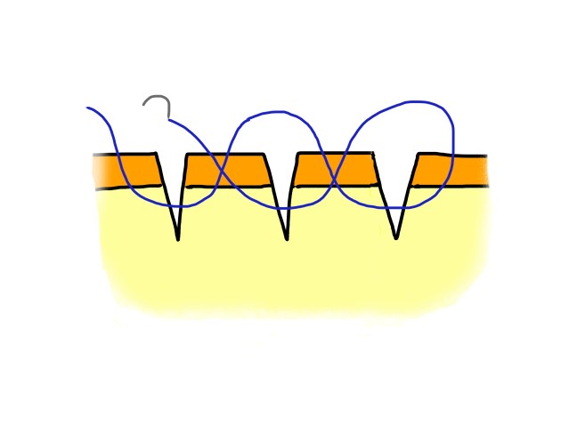 parallel lacerations blank x3c